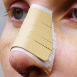 10 Cara Merawat Hidung Setelah Operasi atau Cedera
