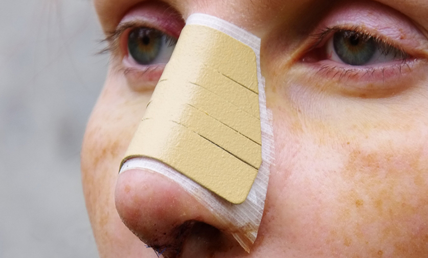 10 Cara Merawat Hidung Setelah Operasi atau Cedera