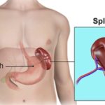 5 Langkah Merawat Limpa setelah Trauma atau Benturan