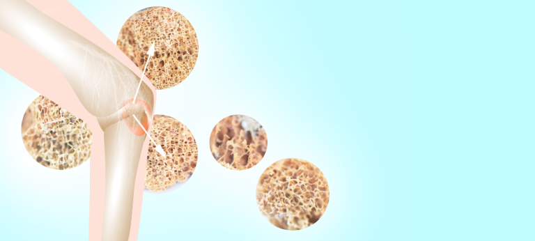 10 Cara Membentuk Tulang yang Sehat Sejak Remaja