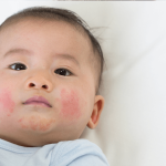 5 Cara Menangani Ruam di Dagu Anak dengan Aman