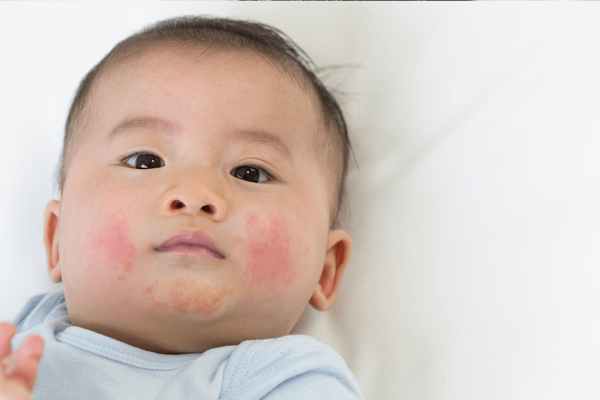 5 Cara Menangani Ruam di Dagu Anak dengan Aman