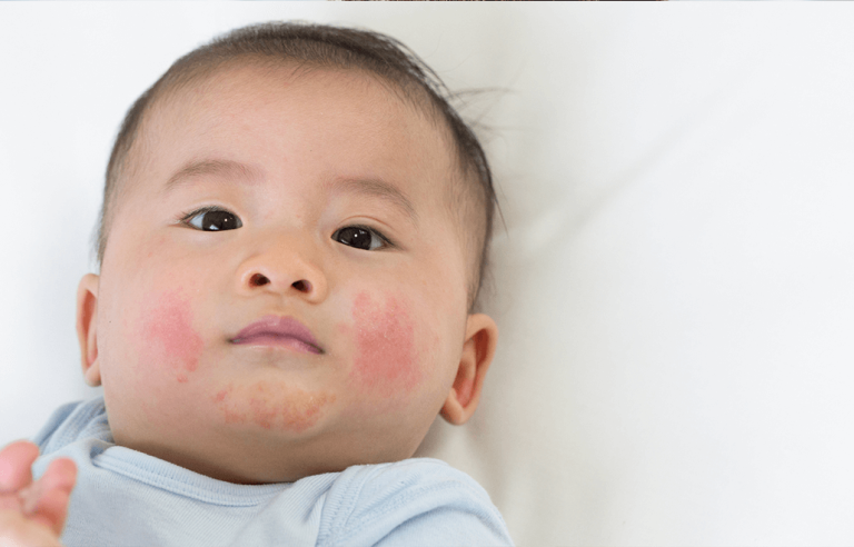 5 Cara Menangani Ruam di Dagu Anak dengan Aman