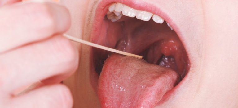 7 Cara Merawat Tenggorokan Setelah Operasi Amandel
