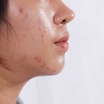10 Cara Mengatasi Kulit Berminyak dan Berjerawat