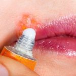 5 Cara Menghindari Infeksi pada Luka di Bibir