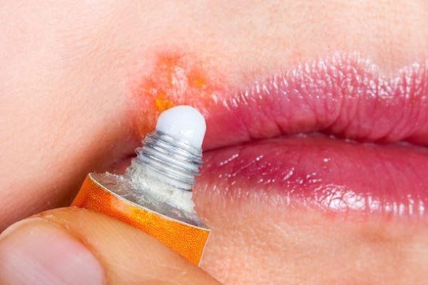 5 Cara Menghindari Infeksi pada Luka di Bibir