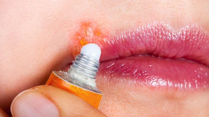 5 Cara Menghindari Infeksi pada Luka di Bibir