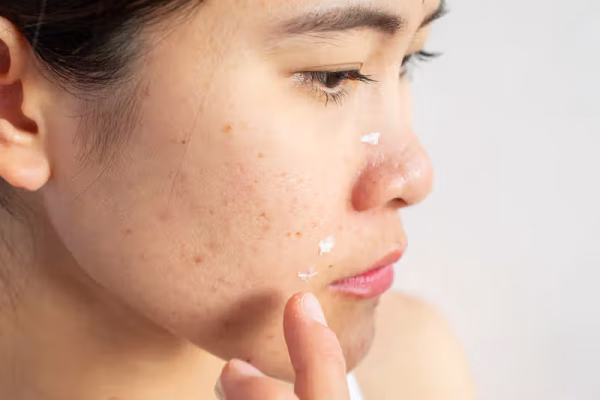 5 Tips Menghindari Jerawat Akibat Produk Kosmetik