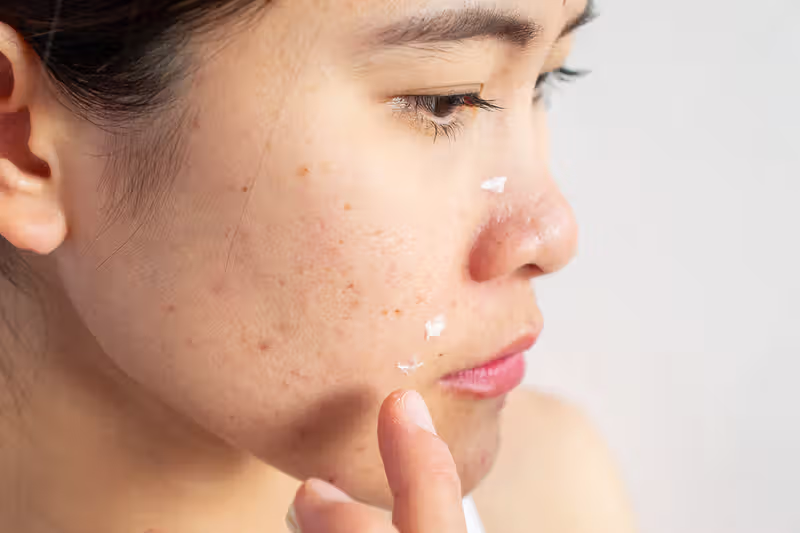 5 Tips Menghindari Jerawat Akibat Produk Kosmetik