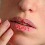 10 Cara Cepat Mengatasi Bibir Terluka atau Lecet