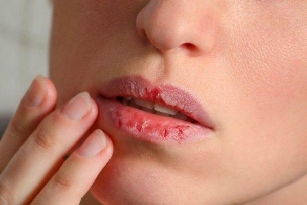 10 Cara Cepat Mengatasi Bibir Terluka atau Lecet