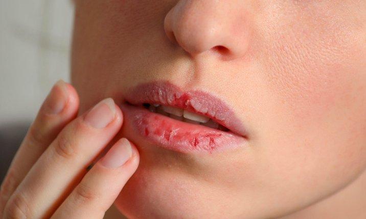 10 Cara Cepat Mengatasi Bibir Terluka atau Lecet